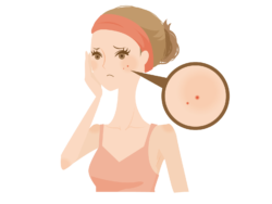 ニキビに悩む女性